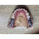 Screwed Retained Hybrid Implant Supported Dentures High Accuracy