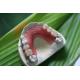 Partial Flexible Invisible Denture For Anterior Teeth