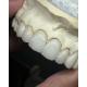 Transluency Layered Zirconia Crown for Optimal Functionality and Natural Aesthetics