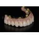 Full Mouth Reconstruction All On 4 All On 6 Dental Implant System