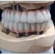 Precision-Crafted Zirconia Implant Screw Cement Retained for Natural-Looking Teeth