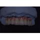 Precision Crafted Dental Implant Crowns For Superior Longevity And Comfort