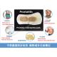Wonderful Male pad prostatic plaster patch sanitary napkin for urinary tract infection prostatitis