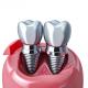 Comfort In Every Aspect Our Dental Implant Crowns