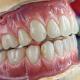 Precise Temporary Full Acrylic Denture Teeth Ivoclar ISO Aprroved