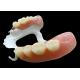 Customized Partial Removable Denture with High-Performance Polymer (HPP) Framework for Superior Comfort and Durability