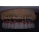 Customizable Silver Dental Crown Precision Fit For Comfortable Restoration