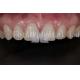 High Translucency Dental Lab Laminate Veneers for Natural and Polishing