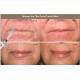 10ml Injectable Hyaluronic Acid Dermal Filler For Correcting Facial Asymmetry