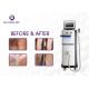 Micro Channel 808 400ms Diode Laser Hair Removal Machine