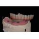 Customizable All On 4 All On 6 Dental Implants For Complete Oral Rehabilitation