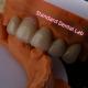 Highly Biocompatible PFZ Porcelain Layered Zirconia With Pink Gum